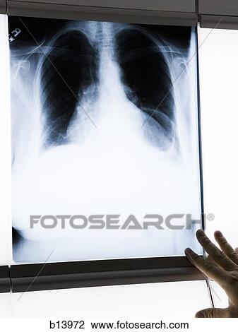 Chest x-ray with male hand View Large Photo Image Stock Image - Chest x-ray with male hand. Fotosearch