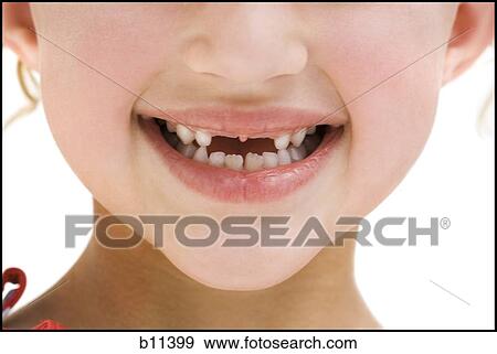 Close-up of young girl's smile with missing front teeth View Large Photo Image Stock Photo - Close-up of young girl's smile with missing front teeth. Fotosearch