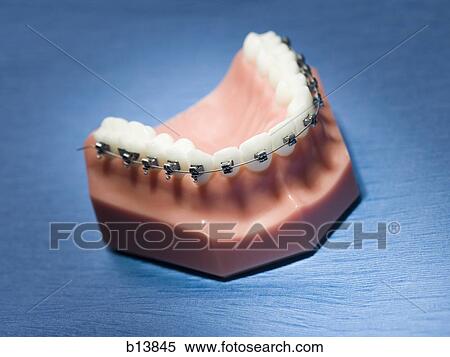 False teeth with braces View Large Photo Image Stock Photography - False teeth with braces. Fotosearch