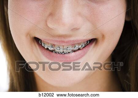 Stock Image - Smiling girl with braces. Fotosearch