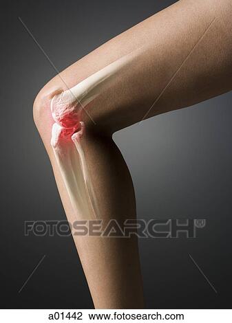 Stock Image - MRI-like image of knee with inflammation. Fotosearch