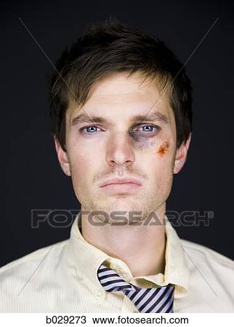 Stock Image - man with a black eye. Fotosearch