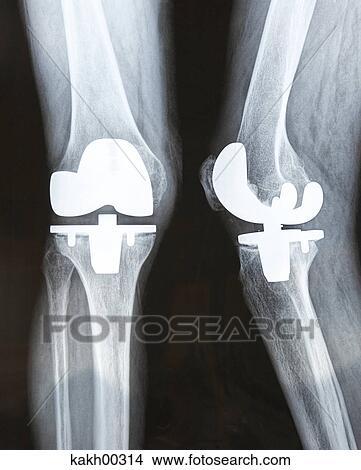 medical, patient, physical, radiograph, leg, radiology, radiogram View Large Photo Image Picture - medical, patient, physical, radiograph, leg, radiology, radiogram. Fotosearch