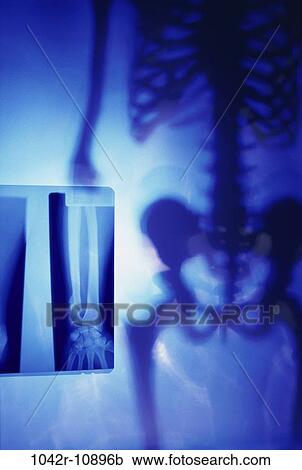 blur, skeleton, arm, health, medical, x-ray View Large Photo Image Stock Image - blur, skeleton, arm, health, medical, x-ray. Fotosearch