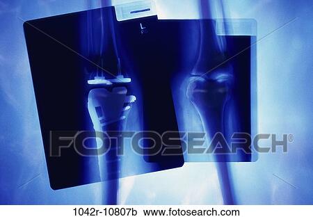 health, medical, joints, implant, x-ray, imaging View Large Photo Image Stock Image - health, medical, joints, implant, x-ray, imaging. Fotosearch