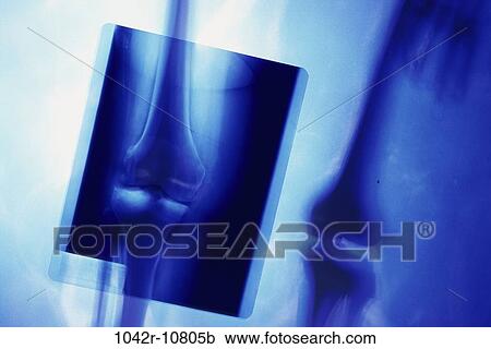health, medical, joints, x-ray, imaging, body part View Large Photo Image Stock Image - health, medical, joints, x-ray, imaging, body part. Fotosearch