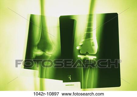 health, medical, knee, joints, implant, x-ray View Large Photo Image Stock Photo - health, medical, knee, joints, implant, x-ray. Fotosearch