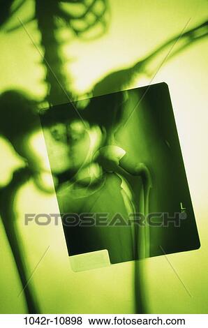 health, medical, pelvis, x-ray, imaging, socket View Large Photo Image Stock Photo - health, medical, pelvis, x-ray, imaging, socket. Fotosearch