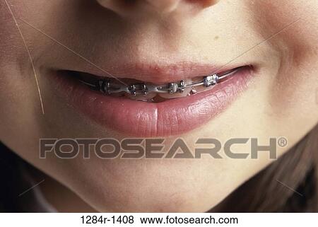Stock Photo - braces, mouth, health, medical, close-up, dental. Fotosearch