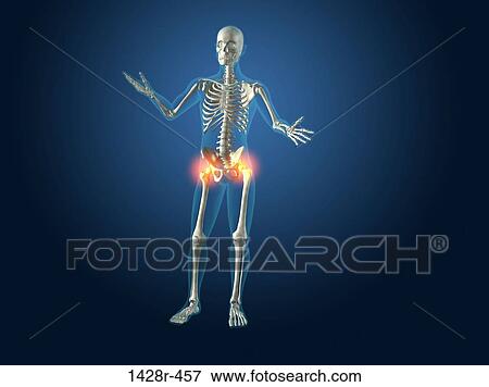 X-ray view of a human skeleton with hip joint inflammation View Large Photo Image Stock Photo - X-ray view of a human skeleton with hip joint inflammation. Fotosearch