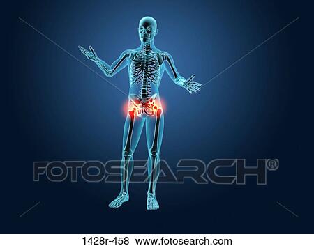 X-ray view of a human skeleton with hip joint inflammation View Large Photo Image Stock Photo - X-ray view of a human skeleton with hip joint inflammation. Fotosearch
