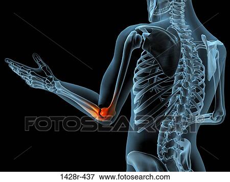 X-ray view of elbow joint with red inflammation in a see-through arm with hand and spinal bones View Large Photo Image Stock Photo - X-ray view of elbow joint with red inflammation in a see-through arm with hand and spinal bones. Fotosearch
