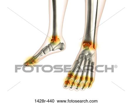 X-ray view of inflamed foot bones View Large Photo Image Stock Image - X-ray view of inflamed foot bones. Fotosearch
