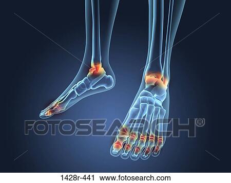 X-ray view of inflamed foot bones View Large Photo Image Stock Image - X-ray view of inflamed foot bones. Fotosearch
