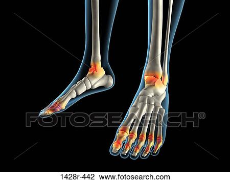 X-ray view of inflamed foot bones View Large Photo Image Stock Image - X-ray view of inflamed foot bones. Fotosearch