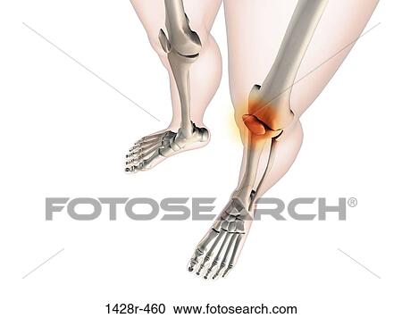 X-ray view of knees with joint inflammations View Large Photo Image Stock Image - X-ray view of knees with joint inflammations. Fotosearch