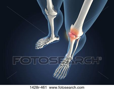 X-ray view of knees with joint inflammations View Large Photo Image Stock Image - X-ray view of knees with joint inflammations. Fotosearch