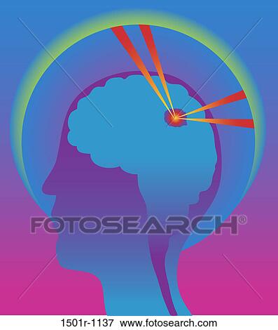 Gamma Knife, illustration View Large Photo Image Stock Photo - Gamma Knife, illustration. Fotosearch
