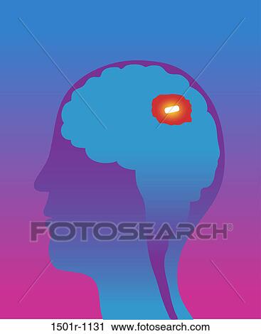 Man's brain with mental pill inside, cross section, illustration View Large Photo Image Stock Image - Man's brain with mental pill inside, cross section, illustration. Fotosearch