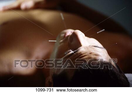 Acupuncture View Large Photo Image Stock Image - Acupuncture. Fotosearch