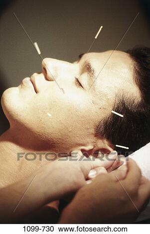 Stock Image - people, acupuncture, health, alternative, brunette, treatment. Fotosearch