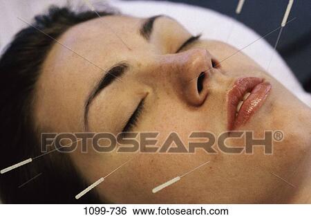 people, woman, acupuncture, health, alternative, brunette View Large Photo Image Stock Photograph - people, woman, acupuncture, health, alternative, brunette. Fotosearch