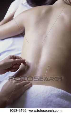 Stock Photo - people, woman, Chinese, patient, back, acupuncture, health. Fotosearch