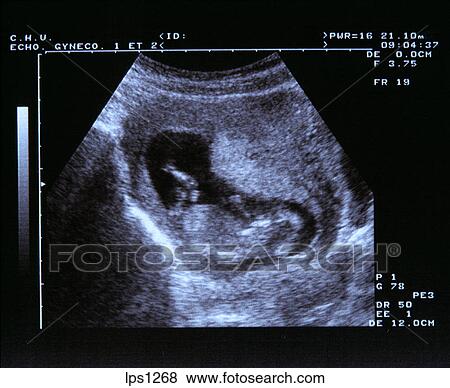 Pictures of 48 Blue Ultrasound Scan Of A 2 Months Old Fetus. lps1268 ...