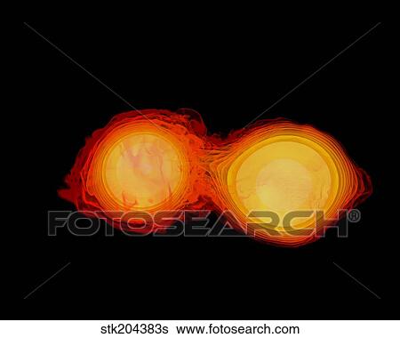 A pair of neutron stars colliding, merging, and forming a black hole. View Large Illustration Stock Illustration - A pair of neutron stars colliding, merging, and forming a black hole.. Fotosearch