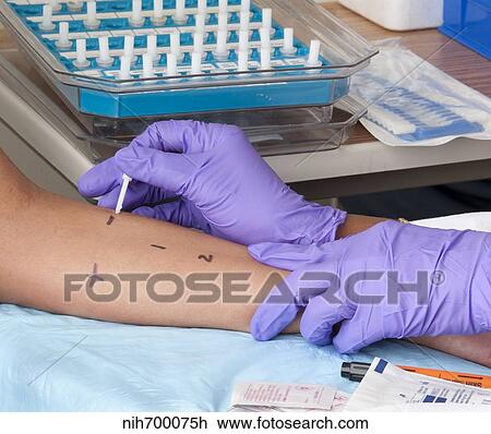 Stock Image - A person receiving a skin prick allergy test.. Fotosearch