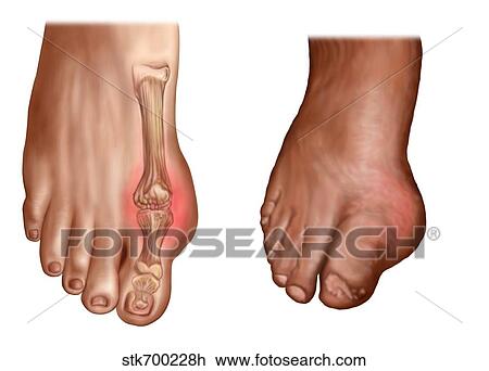 Drawing - Anatomy of a swollen foot.. Fotosearch