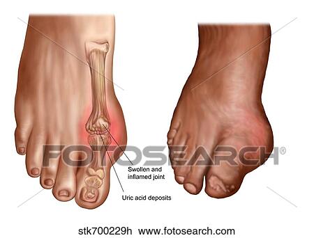 Drawing - Anatomy of a swollen foot.. Fotosearch