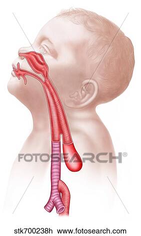 Drawing - Anatomy of a tracheoesophageal fistula.. Fotosearch