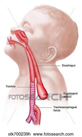 Drawing - Anatomy of a tracheoesophageal fistula.. Fotosearch