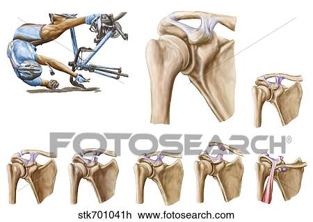 Anatomy of acromioclavicular joint rupture and displacement. View Large Illustration Drawing - Anatomy of acromioclavicular joint rupture and displacement.. Fotosearch