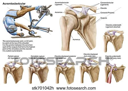 Anatomy of acromioclavicular joint rupture and displacement. View Large Illustration Drawing - Anatomy of acromioclavicular joint rupture and displacement.. Fotosearch