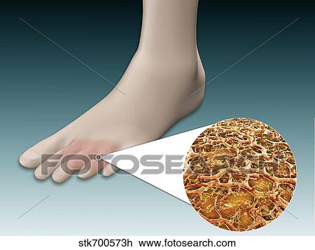 Anatomy of foot fungus with microscopic close-up. View Large Illustration Drawing - Anatomy of foot fungus with microscopic close-up.. Fotosearch