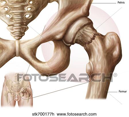 Anatomy of hip fracture. View Large Illustration Drawing - Anatomy of hip fracture.. Fotosearch