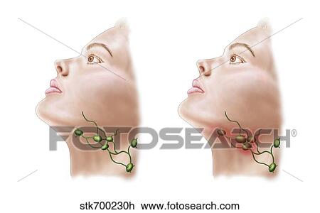 Drawing - Anatomy of swollen lymph nodes.. Fotosearch