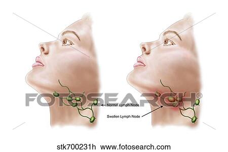 Anatomy of swollen lymph nodes. View Large Illustration Drawing - Anatomy of swollen lymph nodes.. Fotosearch