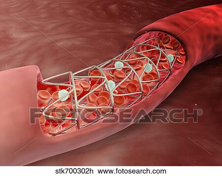 Drawing - Artery cross-section with blood flow and stent deployment.. Fotosearch
