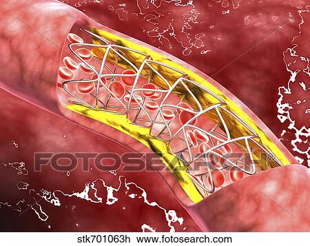Artery cross-section with blood flow, fat plaque and stent deployment. View Large Illustration Drawing - Artery cross-section with blood flow, fat plaque and stent deployment.. Fotosearch