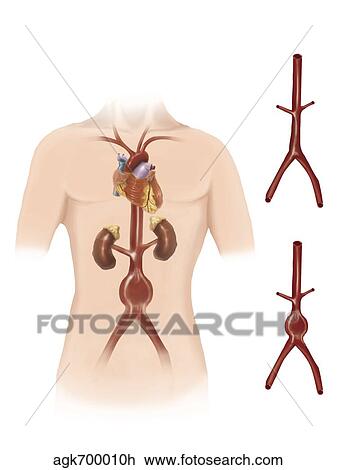 Artist depcition of abdominal aortic aneuryism. View Large Illustration Drawing - Artist depcition of abdominal aortic aneuryism.. Fotosearch