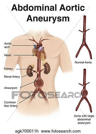 Artist depcition of abdominal aortic aneuryism (with labels). View Large Illustration Drawing - Artist depcition of abdominal aortic aneuryism (with labels).. Fotosearch