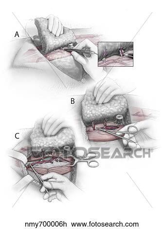 Drawing - Color illustration depicting the three steps of DIEP flap breast reconstruction surgery.. Fotosearch