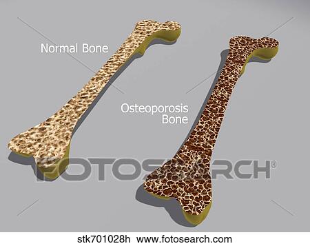 Drawing - Comparison of a healthy bone and a bone with osteoporosis.. Fotosearch