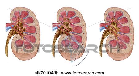 Comparison of different sized kidney stones in the human kidney. View Large Illustration Drawing - Comparison of different sized kidney stones in the human kidney.. Fotosearch