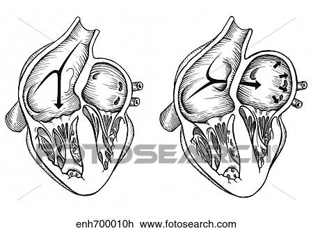 Drawing - Comparison of normal heart versus heart with a patent foramen ovale.. Fotosearch