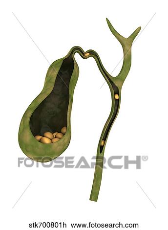 Drawing - Conceptual image of gallstones inside gall bladder.. Fotosearch