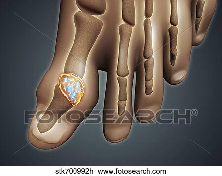 Drawing - Conceptual image of gout in the big toe.. Fotosearch